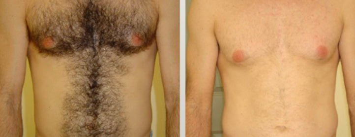Chest and abdomen laser hair removal results before and after using the Soprano ICE Platinum