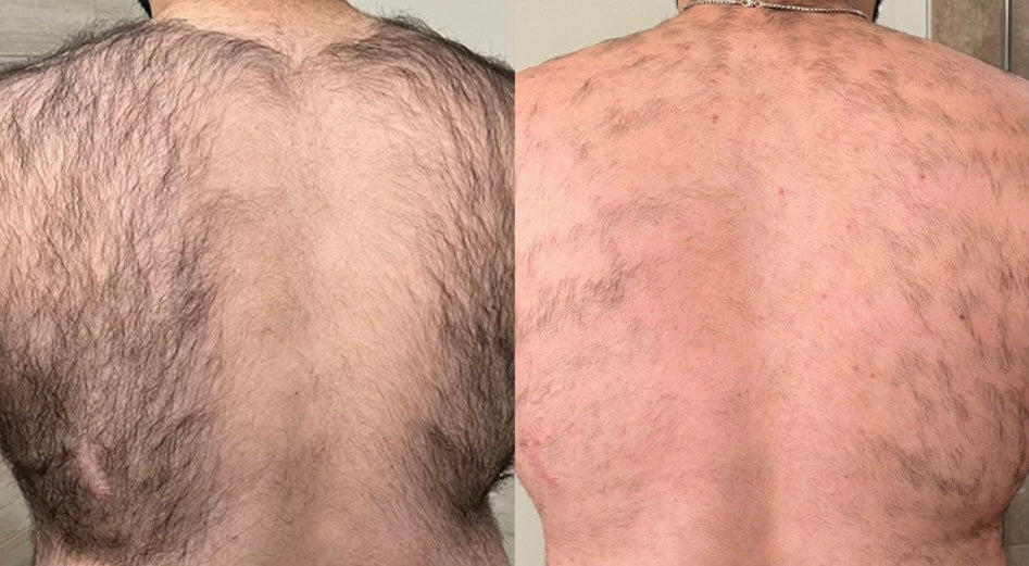 Laser hair removal results on a man's back after 3 treatments using the Soprano ICE Platinum laser